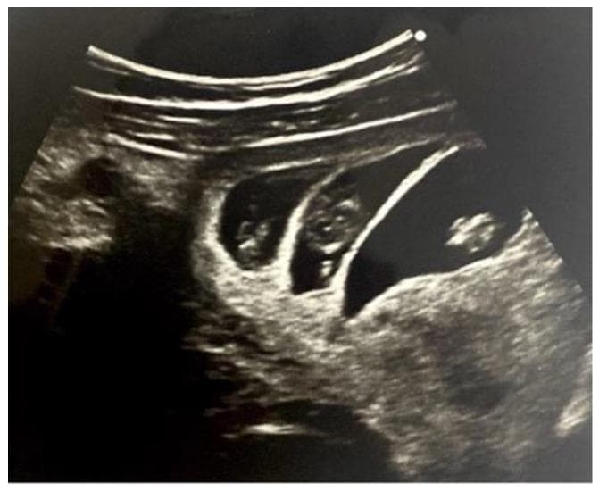 This diagnostic ultrasound image demonstrates a first-trimester trichorionic triamniotic (TCTA) triplet pregnancy at approximately 9 weeks of gestation. The transabdominal scan reveals three distinct gestational sacs within the uterus, each containing a visible embryo. Key diagnostic features include the presence of two 'lambda signs' (also known as the 'twin peak' sign), which are triangular, echogenic projections of chorionic tissue extending into the base of the intertwin membranes. The intertwin membranes themselves are notably thick and multi-layered, consisting of a central layer of chorion sandwiched between two amniotic layers, indicating high chorionicity. These findings are critical for establishing chorionicity and amnionicity in multiple gestations, which is essential for risk stratification and clinical management. The presence of three separate sacs and thick separating membranes confirms that each fetus has its own placenta and amniotic sac, distinguishing this from monochorionic triplet pregnancies.