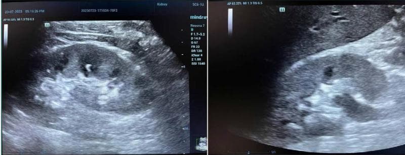 Two grayscale ultrasound images in longitudinal and transverse planes demonstrating renal calculi (nephrolithiasis) within a human kidney. The diagnostic images reveal the renal parenchyma with a clearly defined corticomedullary junction. Inside the renal pelvis/calyceal system, there are distinct hyperechoic (bright white) foci representing renal stones. A key diagnostic feature shown is posterior acoustic shadowing—a dark vertical band extending behind the hyperechoic stones caused by the reflection and absorption of sound waves. The images facilitate the comparison of echogenicity between the relatively hypoechoic renal cortex and the highly echogenic stones. This visual material is used in radiology education to teach the sonographic identification of kidney stones, focusing on morphology, echogenicity, and the presence of acoustic artifacts as definitive diagnostic criteria.