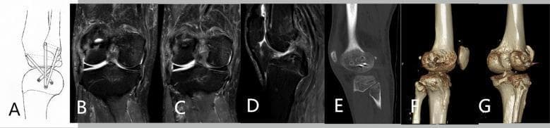 This composite figure illustrates surgical management for posterolateral corner (PLC) knee instability using a modified LaPrade technique. Panel A presents a line diagram showing the graft configuration for anatomical reconstruction of the fibular collateral ligament (FCL), popliteus tendon (PT), and popliteofibular ligament (PFL). Panels B-D are preoperative MRI scans (coronal and sagittal views) displaying the native knee anatomy and soft tissue structures including the menisci and cruciate ligaments. Panels E-G show postoperative imaging: E is a sagittal CT slice demonstrating surgical bone tunnels, while F and G are 3D CT reconstructions of the knee joint. These reconstructions highlight the precise placement of femoral, tibial, and fibular bone tunnels and the presence of interference screws used for graft fixation. The series serves as an educational resource for orthopedic surgery, specifically focusing on complex knee ligament reconstruction and the radiographic assessment of tunnel positioning and hardware integration in multi-ligamentous knee injuries.