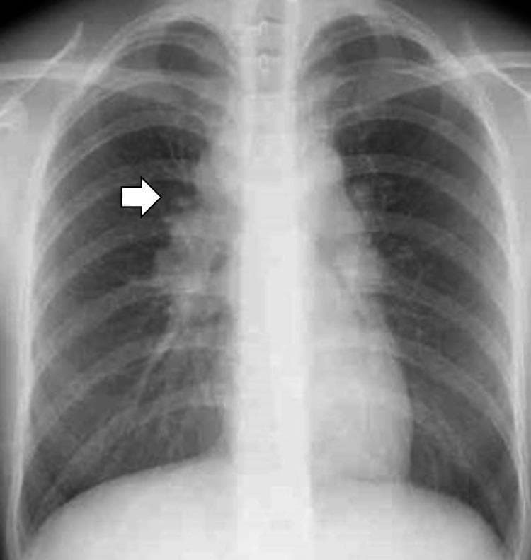 A posteroanterior (PA) chest radiograph demonstrating bilateral hilar enlargement, a classic radiological sign often associated with Stage I sarcoidosis. The image shows well-defined, lobulated opacities in both the left and right hilar regions, representing hilar lymphadenopathy. A white arrow specifically highlights the right hilar adenopathy. The lung parenchyma appears relatively clear with no obvious interstitial markings or focal consolidations. The mediastinal contour is slightly widened, likely due to paratracheal lymphadenopathy. Heart size is within normal limits, and the costophrenic angles are sharp, indicating no pleural effusion. The trachea is midline, and the bony structures, including the clavicles and ribs, appear intact. This diagnostic image is a key educational example for medical students learning the differential diagnosis of bilateral hilar lymphadenopathy, which includes sarcoidosis, lymphoma, and certain infections.
