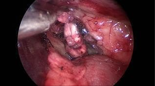 This endoscopic clinical photograph captures an intraoperative view of a retroperitoneal surgical procedure, specifically focusing on the exposure and mobilization of the adrenal gland. The adrenal gland is visible as an irregular, elongated structure with a mottled tan and reddish appearance, situated within the retroperitoneal fat. A Kelly forceps is actively engaged in the surgical field; however, rather than grasping the gland directly to avoid parenchymal damage, the instrument is seen gripping the adjacent periadrenal connective and adipose tissue for retraction. The surrounding anatomy includes partially dissected fascia and fatty tissue, with the kidney and associated renal vasculature located in the nearby operative field. The image demonstrates a key step in adrenalectomy, highlighting the surgical technique of using periadrenal tissue as a handle to facilitate the circumferential dissection of the gland from its attachments, including the phrenicoabdominal vein and visceral adrenal capsule.
