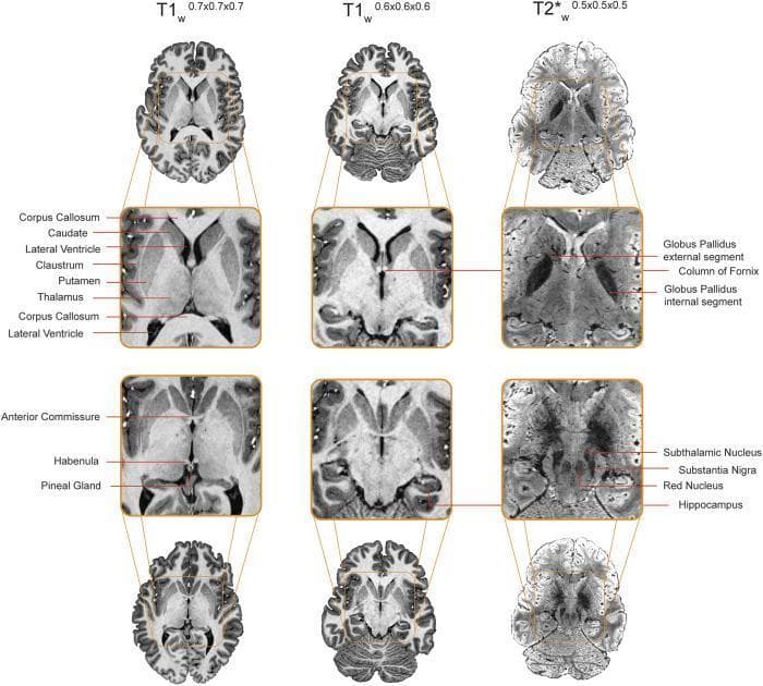 Diagnostic neuroimaging comparison featuring three axial MRI sequences of a human brain at varying spatial resolutions: T1-weighted (0.7mm³ and 0.6mm³) and T2*-weighted (0.5mm³). The image illustrates the differential contrast and visibility of subcortical structures based on sequence weighting. In the T1-weighted columns, there is high contrast between gray and white matter, clearly delineating the Corpus Callosum, Caudate, Putamen, Thalamus, Claustrum, and the dark signal of the Lateral Ventricles. The T2*-weighted column displays a different contrast profile, where fluid in the ventricles appears brighter and iron-rich structures are more prominently visualized. Key labels in the T2* sequence identify deep brain nuclei including the Globus Pallidus (internal and external segments), Subthalamic Nucleus, Substantia Nigra, and Red Nucleus, alongside the Hippocampus and Column of Fornix. Other labeled midline structures include the Anterior Commissure, Habenula, and Pineal Gland. This comparison highlights the clinical necessity of multi-modal MRI acquisition for comprehensive evaluation of subcortical anatomy and pathology.