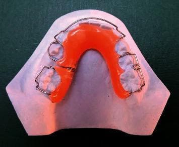 A top-down clinical photograph of a removable orthodontic appliance, specifically a space-regainer plate, seated on a white dental stone cast of a human mandibular or maxillary arch. The appliance features a bright orange acrylic lingual baseplate that provides the structural framework. Integrated into the baseplate are several metallic components: a labial bow (Hawley's loop) arching across the anterior teeth to provide support and control, and multiple stainless steel retention clasps (including Adams clasps) positioned bilaterally to secure the device to the posterior teeth. A key feature is a built-in distalizing screw mechanism located on the left side of the appliance, which is used for active space regaining by applying controlled distal force to a specific tooth or group of teeth. This educational image illustrates a common interceptive orthodontic device used to manage space loss in the mixed dentition stage, demonstrating the integration of active mechanical components with a passive acrylic base.