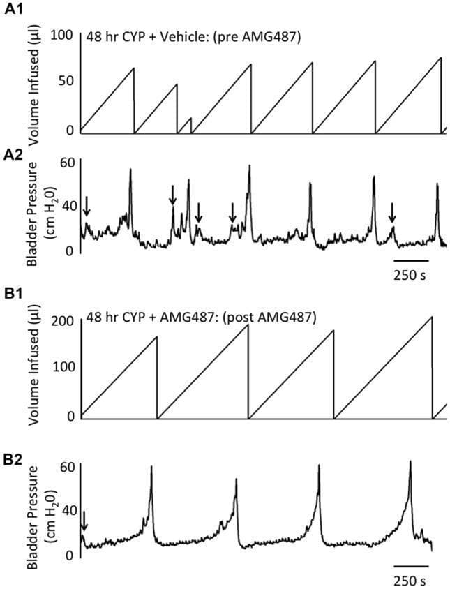 This diagnostic graphic presents cystometrogram recordings from a mouse model of cyclophosphamide (CYP)-induced cystitis, comparing bladder function before and after CXCR3 receptor blockade. The data is divided into two sections: Panel A (Pre-AMG487) and Panel B (Post-AMG487). Each section includes two synchronized tracings: Volume Infused (μl) in charts A1 and B1, and Bladder Pressure (cm H2O) in charts A2 and B2. In the pre-treatment phase (A1, A2), the bladder demonstrates frequent voiding cycles with low capacity (~50 μl) and numerous non-voiding contractions (indicated by arrows). Following intravesical infusion of the CXCR3 antagonist AMG487 (B1, B2), there is a significant increase in bladder capacity (~200 μl) and a marked reduction in voiding frequency and non-voiding contractions. The pressure tracings in B2 show more stable filling phases and distinct, higher-amplitude micturition peaks. These findings illustrate the role of the CXCR3 pathway in bladder hyperreflexia and the potential therapeutic efficacy of CXCR3 blockade in managing interstitial cystitis or overactive bladder symptoms.