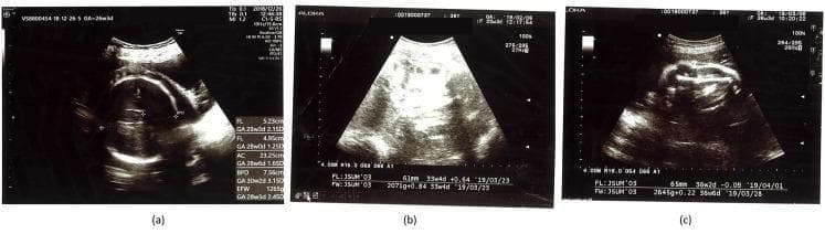 This composite diagnostic image consists of three panels (a, b, and c) showing obstetric ultrasound scans used for fetal biometry and growth monitoring in the context of Gestational Diabetes Mellitus (GDM). Panel (a) displays a transverse section of the fetal head and abdomen at 26 weeks gestation, with caliper measurements showing significantly accelerated growth. Visible biometry includes a biparietal diameter (BPD) of 7.66 cm (30w2d), femur length (FL) of 4.95 cm (28w0d), and abdominal circumference (AC) of 23.25 cm (28w6d), indicating macrosomia or large-for-gestational-age (LGA) status due to maternal hyperglycemia. Panels (b) and (c) track subsequent fetal development at 33w4d and 36w2d respectively, showing estimated fetal weights (EFW) of 2071g and 2645g. These longitudinal scans illustrate the impact of clinical interventions, such as dietary modifications and caloric restriction, on slowing excessive fetal weight gain to achieve a growth trajectory closer to the normal range. The clinical significance focuses on ultrasound's role in monitoring metabolic complications and the efficacy of glycemic control in pregnancy.