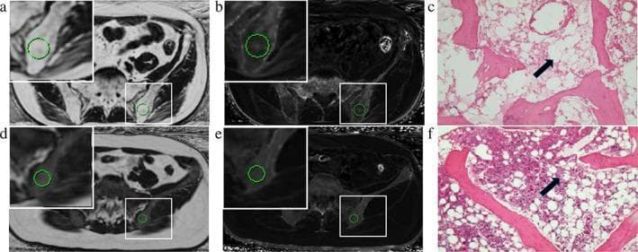 A multi-modal comparison of bone marrow characteristics between Aplastic Anemia (AA) and Myelodysplastic Syndromes (MDS). Panels A, B, D, and E show axial magnetic resonance (MR) images of the pelvis at the level of the left posterior superior ilium. Panels A and D are fat fraction (FF) maps, where the ROI in AA (A) displays significantly higher signal hyperintensity (86.98% FF) compared to MDS (D, 25.84% FF), indicating extensive fatty replacement of marrow. Panels B and E represent R2* maps used for iron content quantification (117.91 vs 147.98/second). Panels C and F provide corresponding H&E stained histological sections of the bone marrow. The AA section (C) demonstrates hypocellularity with a marked increase in large, clear adipocytes (black arrow) and sparse hematopoietic cells. In contrast, the MDS section (F) shows hypercellular marrow with higher hematopoietic cell density and fewer adipocytes (black arrow) amidst bone trabeculae. This composite image illustrates the clinical application of IDEAL-IQ MRI sequences in differentiating marrow failure syndromes by correlating quantitative imaging metrics with histopathological findings.