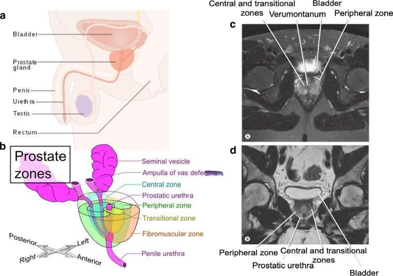 This composite educational graphic illustrates the positional and zonal anatomy of the human prostate gland. Panel (a) is a sagittal schematic showing the prostate’s location inferior to the bladder and anterior to the rectum within the male pelvic cavity. Panel (b) provides a detailed 3D anatomical diagram of the prostate zones as defined by McNeal. It highlights the peripheral zone (posterior/lateral), transitional zone (surrounding the prostatic urethra), central zone (superior/base), and anterior fibromuscular stroma. Associated structures like the seminal vesicles and ampulla of vas deferens are depicted. Panels (c) and (d) present axial and coronal T2-weighted magnetic resonance imaging (MRI) scans, respectively. These diagnostic images correlate the schematic zones to clinical findings, identifying the hyperintense peripheral zone and relatively hypointense central/transitional zones. Key landmarks labeled include the bladder, verumontanum, and prostatic urethra. This resource is designed for medical education to aid in the radiological and clinical localization of prostate pathologies such as BPH and adenocarcinoma.