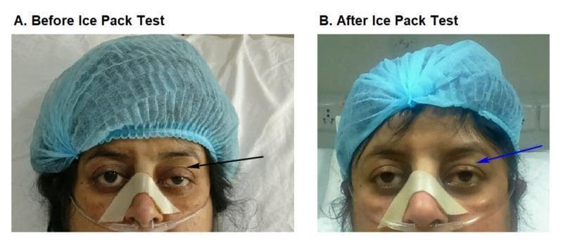 Two side-by-side clinical photographs labeled A and B demonstrate a bedside ice pack test in a patient with suspected myasthenia gravis. Image A (Before Ice Pack Test) shows significant left-sided blepharoptosis, with the upper eyelid drooping to partially cover the pupil (indicated by a black arrow). Image B (After Ice Pack Test) demonstrates a positive result, where the left eyelid shows temporary elevation and resolution of ptosis (indicated by a blue arrow) following local cooling. The patient is shown in a clinical setting wearing a blue surgical cap, a nasal cannula for oxygen delivery, and an adhesive nasal strip for stabilization. This comparative series illustrates the clinical utility of the ice pack test, which inhibits acetylcholinesterase activity at the neuromuscular junction to temporarily improve muscle strength in myasthenic patients. The images highlight key diagnostic physical exam findings in neuro-ophthalmology and neuromuscular medicine.