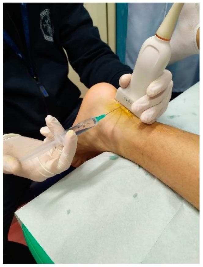 This clinical photograph demonstrates an ultrasound-guided high-volume image-guided injection (HVIGI) performed on the mid-portion of a patient's Achilles tendon. The patient is positioned prone with the ankle slightly elevated on a sterile disposable sheet. A clinician wearing protective gloves is using a high-frequency linear ultrasound transducer, applied with acoustic coupling gel, to visualize the tendon in real-time. Simultaneously, a needle attached to a large-capacity syringe containing clear saline or local anesthetic is inserted percutaneously into the paratendinous space. The procedure aims to mechanically strip the paratenon from the tendon and disrupt neo-vessels or nerves associated with chronic tendinopathy. This image serves as an educational reference for minimally invasive musculoskeletal procedures and ultrasound-guided interventional techniques in sports medicine and orthopedics for managing resistant Achilles tendinopathy.