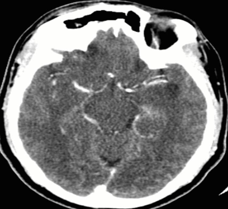 This diagnostic image is an axial slice from a Computed Tomography Angiogram (CTA) of the brain, demonstrating the intracranial vasculature at the level of the Circle of Willis. The primary clinical focus is the evaluation of the left middle cerebral artery (MCA) following thrombolytic therapy with alteplase. The image shows contrast opacification and partial recanalization of the M1 segment of the left MCA, which appears as a hyperdense, linear structure relative to the adjacent parenchyma. An area of subtle hypodensity is visible in the left temporal lobe, consistent with an ischemic territory post-stroke. The anterior circulation, including segments of the internal carotid arteries and right MCA, demonstrates continuity of contrast. This imaging is characteristic of post-thrombolysis monitoring in acute ischemic stroke, used to assess for vessel patency, recanalization status, and the development of collateral circulation. It is a critical resource for neurology and radiology students studying neurovascular emergencies and treatment outcomes.