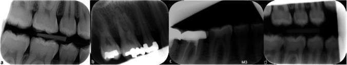 A composite of four intraoral dental radiographs (a–d) demonstrating common 'cone cut' technical errors, categorized by the location of the unexposed area. Panel (a) is a bitewing radiograph showing a distal (D) cone cut on the left margin, where a radiopaque bite block is visible between the maxillary and mandibular molars. Panel (b) illustrates a caudal or 'below' (B) cone cut affecting the apical regions of the teeth. Panel (c) shows a cranial or 'above' (A) cone cut that obscures the crowns and superior structures, featuring a prominent radiopaque dental restoration. Panel (d) displays a mesial (M) cone cut on the right side of the image. These diagnostic images serve as educational examples for radiological quality assessment, specifically identifying how misalignment of the X-ray beam relative to the sensor results in partial loss of clinical data, such as missing root apices, alveolar bone levels, or interproximal contacts.