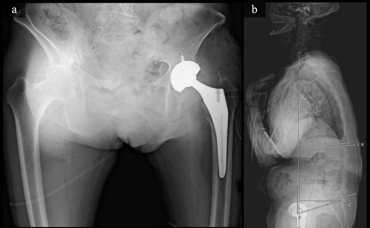 This composite of two diagnostic X-ray radiographs displays postoperative evaluations in an orthopedic context. Panel (a) is an anteroposterior radiograph of the pelvis and hips, demonstrating a right total hip arthroplasty (THA). The prosthesis consists of a cementless acetabular cup reinforced with screw fixation and a tapered wedge-type cementless femoral stem. The contralateral hip appears intact for comparison. Panel (b) shows a full-length lateral upright spine radiograph used for sagittal balance assessment. Annotated measurements illustrate global sagittal alignment, including the sagittal vertical axis (SVA), lumbar lordosis (LL) angle, and pelvic tilt (PT). The imaging highlights clinical findings of decreased lumbar lordosis (8°) and anterior trunk tilt (SVA 103 mm), indicating significant sagittal plane imbalance. These images demonstrate the relationship between hip replacement surgery and spinopelvic parameters, commonly analyzed in patients with complex degenerative conditions or Rapidly Destructive Coxopathy (RDC).