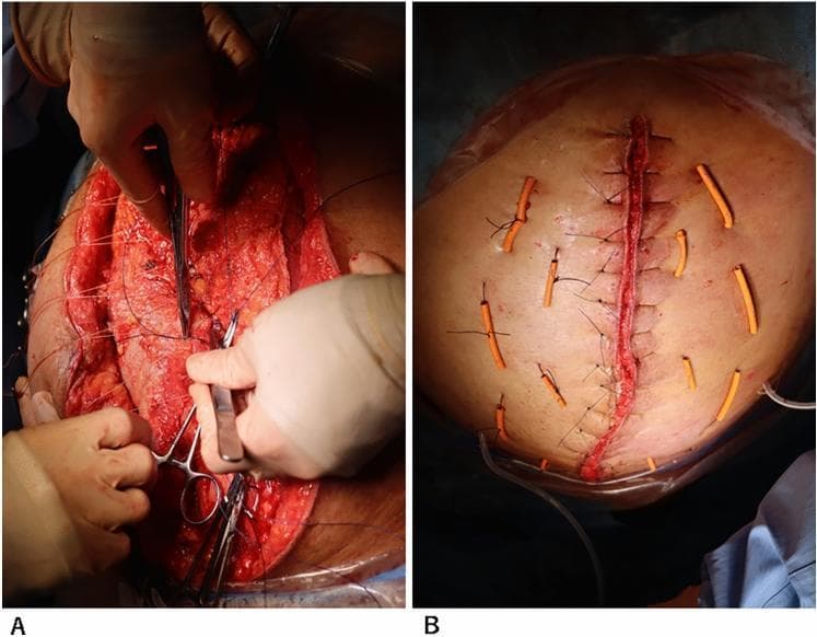 Two-panel clinical photograph demonstrating advanced abdominal wall closure techniques following a complex laparotomy. Panel A shows an intraoperative surgical field during a components separation technique. Surgeons are using forceps and surgical clamps to manipulate fascial layers and musculature. Heavy-duty sutures are visible running laterally through the tissue, facilitating the approximation of the abdominal wall layers under tension. Panel B displays the immediate postoperative result of the abdominal closure. A primary, continuous vertical suture line runs along the midline incision. To reinforce the closure and prevent dehiscence, multiple interrupted retention sutures are placed bilaterally. These retention sutures are supported by orange, rubberized bolster tubes (bumpers) that distribute pressure across the skin surface to prevent suture-induced tissue necrosis or 'cheese-wiring.' This technique is typically employed in patients with high intra-abdominal pressure or poor wound healing to achieve definitive closure.