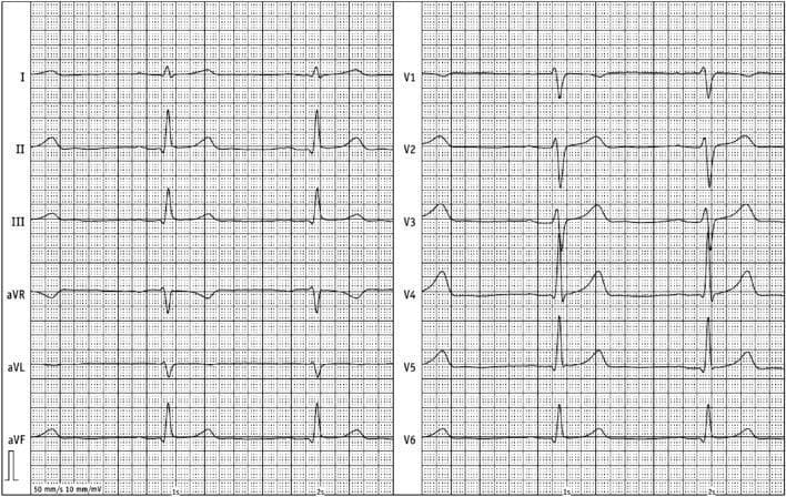 This diagnostic image is a 12-lead electrocardiogram (ECG/EKG) demonstrating classic features associated with acute pericarditis. The tracing shows widespread ST-segment changes across multiple vascular territories. Specifically, there are concave, 'saddle-back' ST-segment elevations most prominent in the inferior leads (II, III, aVF) and lateral precordial leads (V4, V5, V6). Corresponding PR-segment depression is visible in the same leads, while lead aVR shows reciprocal ST-segment depression and PR-segment elevation. The T waves are generally upright and symmetric in the leads with ST elevation, although slight inversion is noted in lead aVR and aVL. The rhythm appears to be a normal sinus rhythm with a regular rate. These diffuse repolarization abnormalities, characterized by their non-concordance with a single coronary artery distribution and the saddle-back morphology, are key educational indicators for differentiating pericardial inflammation from acute myocardial infarction. The image serves as a clinical example of cardiac repolarization changes in the context of pericarditis and pericardial effusion.