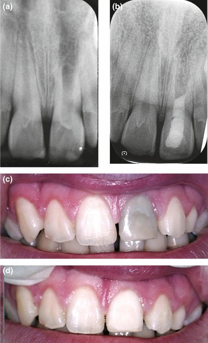 This composite educational resource consists of diagnostic periapical radiographs and clinical photographs demonstrating the management of a non-vital, discolored left maxillary central incisor.
Panel (a) shows a preoperative periapical radiograph of the left maxillary central incisor exhibiting interrupted root development, a wide pulp canal, and periapical radiolucency, indicative of pulp necrosis in an immature tooth. Panel (b) illustrates the post-treatment radiograph after regenerative endodontic procedures, showing a radiopaque intracanal filling material and improved root morphology.
Panel (c) is a clinical photograph showing severe greyish-black extrinsic/intrinsic discoloration of the same incisor compared to adjacent teeth. Panel (d) shows the clinical result following three internal/external bleaching appointments, demonstrating a significant aesthetic improvement with the tooth shade now harmonizing with the surrounding dentition. This case serves as a clinical example of regenerative endodontic protocols and non-invasive aesthetic management of tooth discoloration resulting from trauma or necrosis.