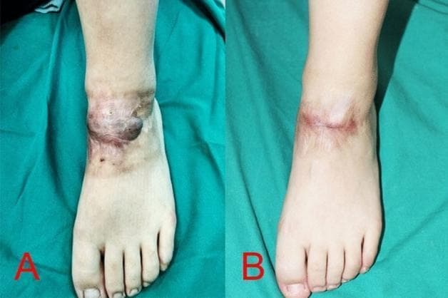 Clinical photograph comparison of a traumatic keloid scar on the dorsum of the left foot before (A) and after (B) intralesional diode laser treatment. Image A shows a highly elevated, irregularly shaped, hyperpigmented keloid mass crossing the anterior ankle joint. The lesion exhibits nodular texture with dark purplish and reddish-brown coloration, extending distally toward the midfoot. Image B demonstrates the clinical outcome after two sessions of 1470 nm bare-fiber diode laser therapy. There is a significant reduction in scar volume and height, with the mass appearing flattened. The hyperpigmentation has transitioned to a more uniform, light pinkish tone, indicating reduced vascularity and inflammation. The surrounding skin shows improved texture and blending, illustrating the efficacy of intralesional laser ablation in managing large keloid scars in areas of high tension like the ankle.