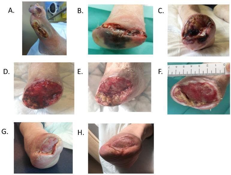 A longitudinal series of eight clinical photographs (A–H) documenting the management and healing progression of a diabetic foot ulcer following various levels of amputation. Image (A) shows initial hallux and first ray necrosis with infection. Subsequent images (B–C) depict the surgical site following transmetatarsal and Lisfranc amputations, characterized by deep, irregular wound beds with fibrin, slough, and dark necrotic tissue. Images (D–E) illustrate the transition to a healthy, beefy-red granulation tissue bed following wound environment control and debridement. Image (F) shows the prepared wound bed prior to skin grafting, with a metric ruler for scale. Final images (G–H) track the outcome of the skin graft over three months, demonstrating progressive contraction and complete epithelialization. The series highlights clinical markers of healing, including the reduction of necrotic slough, the emergence of vascularized granulation tissue, and the final transition to mature, pigmented skin coverage.