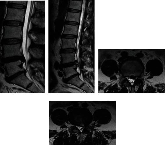 Diagnostic imaging series comprising sagittal and axial (labeled as coronal in clinical notes) T2-weighted MRI scans of the lumbar spine, specifically focusing on the L4-L5 intervertebral disc level. The series functions as a pre- and post-operative comparison for a prolapse poroscopy (percutaneous endoscopic lumbar discectomy). The preoperative sagittal view demonstrates a significant posterior disc herniation (prolapse) causing narrowing of the spinal canal and mechanical compression of the thecal sac. Corresponding axial sections show a focal disc protrusion resulting in lateral recess stenosis. Post-operative images illustrate the results of nucleus pulposus extraction, characterized by a visible reduction in the size of the herniated disc material, improved canal dimensions, and decompression of the neural elements. A minor signal intensity change is noted at the surgical site. This comparison is used to evaluate the efficacy of minimally invasive endoscopic spinal decompression and to assess for any residual disc material or nerve root impingement.