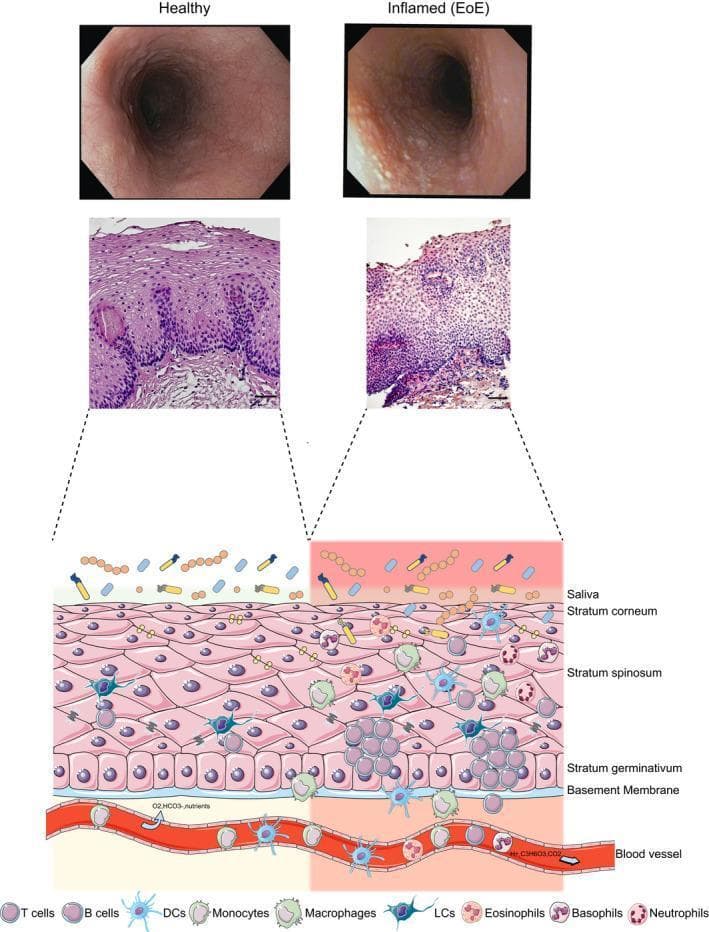 Educational comparison of healthy esophagus versus Eosinophilic Esophagitis (EoE), presented through endoscopic, histological, and schematic views. The top row features macroscopic endoscopic photographs: the healthy esophagus shows a smooth, pale pink lumen, while the EoE esophagus exhibits characteristic longitudinal furrowing and white exudates (micro-abscesses). The middle row presents H&E stained histological sections, with the EoE slide demonstrating significant intraepithelial eosinophil infiltration and basal cell hyperplasia compared to the structured healthy tissue. The bottom section is a pathophysiology diagram illustrating the esophageal layers (stratum corneum, spinosum, germinativum, and basement membrane). In the healthy state (left), immune cell presence is minimal, primarily consisting of T cells and Langerhans cells. In the inflamed EoE state (right), there is a dense recruitment of immune cells from the vasculature, including eosinophils, basophils, neutrophils, dendritic cells, B cells, macrophages, and monocytes, highlighting the Th2-mediated chronic inflammatory response.