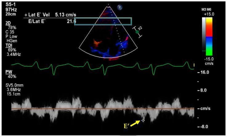 This diagnostic image demonstrates a Tissue Doppler Imaging (TDI) echocardiogram used to assess myocardial velocity and diastolic function. The display is divided into three primary sections: Top: A 2D sector image of the heart (likely an apical four-chamber view) with color-coded Doppler overlays. The color scale on the right indicates flow direction, with red representing movement toward the transducer and blue away. Middle: A simultaneous green electrocardiogram (ECG) tracing providing cardiac cycle synchronization. Bottom: A pulsed-wave (PW) tissue Doppler spectral waveform showing myocardial velocities over time. A yellow arrow identifies the 'E\' peak', which represents the early diastolic mitral annular velocity. Quantitative measurements are overlaid in the upper-left corner, showing a lateral E' velocity (Lat E' Vel) of 5.13 cm/s and an elevated E/Lat E' ratio of 21.6. These findings are clinically significant as an elevated E/E' ratio (typically >14) is a primary indicator of increased left ventricular filling pressures and diastolic dysfunction.