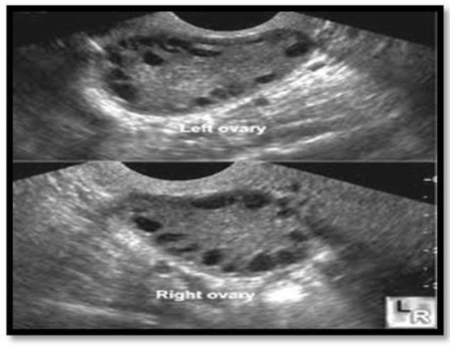 Diagnostic ultrasound imaging displaying a split-view of the left and right ovaries in a patient with Polycystic Ovary Syndrome (PCOS). Both ovaries exhibit classic sonographic features of polycystic morphology, characterized by an increased ovarian volume and a high count of small, peripherally arranged antral follicles. The follicles appear as multiple anechoic (dark), circular, or oval structures, typically measuring between 2 to 9 mm in diameter, creating a 'string of pearls' appearance. The central ovarian stroma is echogenic (brighter gray) and appears thickened or hypertrophied. Each ovary contains more than 12 visible follicles, meeting the Rotterdam diagnostic criteria for PCO. This clinical photograph is a primary tool in reproductive endocrinology and gynecology for evaluating menstrual irregularities, hyperandrogenism, and infertility. It serves as an educational reference for distinguishing normal follicular development from the pathological follicular arrest seen in PCOS.