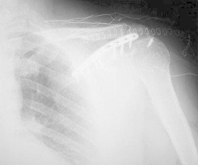 This diagnostic image is an early postoperative anteroposterior (AP) X-ray of the left shoulder. It demonstrates surgical fixation of a scapular spine fracture or pseudoarthrosis. A radiopaque metallic Locking Compression Plate (LCP) is visible, anatomically contoured and positioned along the spine of the scapula. The plate is secured with multiple cortical screws providing internal fixation and compression across the bony disruption. Key anatomical structures visible include the scapula (acromion and spine), the proximal humerus, the clavicle, and the upper rib cage. Radio-dense surgical staples or sutures are also visible in the overlying soft tissue, indicating recent wound closure. The image illustrates orthopedic management for complex scapular injuries and the use of internal fixation to promote bony union in cases of non-union or pseudoarthrosis. The humeral head is noted in the glenohumeral joint, and the hardware appears stable in this early follow-up phase.