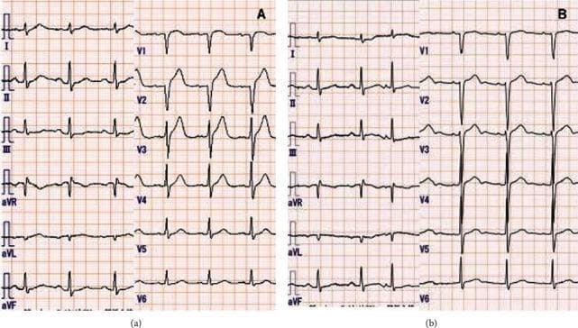 This comparison chart displays two 12-lead electrocardiograms (ECG) labeled (a) and (b), demonstrating the transient nature of vasospastic angina. ECG (a) shows significant ST-segment elevation in the anterior precordial leads, specifically V2, V3, and V4, consistent with an acute transmural myocardial injury pattern. Reciprocal ST-segment depressions are subtly visible in limb leads I and aVL. ECG (b) illustrates the same patient's cardiac rhythm following sublingual nitroglycerin administration, showing a complete resolution of the ST-segment elevations and a return to a baseline isoelectric ST-segment morphology in all leads. The educational focus of this image is the recognition of Prinzmetal (vasospastic) angina, where coronary artery spasm causes reversible ST elevation. Key clinical features include the dynamic shift from an injury pattern during symptomatic episodes to a normal or baseline ECG after vasodilator therapy. The material is suitable for medical students and clinicians studying cardiovascular diagnostics and acute coronary syndromes.