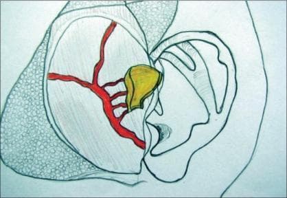 This medical illustration depicts the surgical anatomy and harvesting of a vascularized conchal cartilage flap from the ear, frequently used for temporomandibular joint (TMJ) reconstruction. The diagram shows the external ear with a highlighted yellow segment representing the harvested auricular cartilage. A critical component shown is the superficial temporal artery (STA) and its branching vascular network, rendered in red, which provides the arterial supply to the soft tissue cuff (temporoparietal fascia or TPF) attached to the cartilage. The illustration demonstrates the spatial relationship between the donor site at the cymba conchae/helix root and the arterial pedicle, highlighting the importance of preserving vascularity for the successful creation of an autologous, vascularized interpositional flap. This content is intended for surgical planning and education in plastic surgery and maxillofacial procedures, illustrating the technique of harvesting a composite tissue graft with its associated blood supply to ensure graft viability.