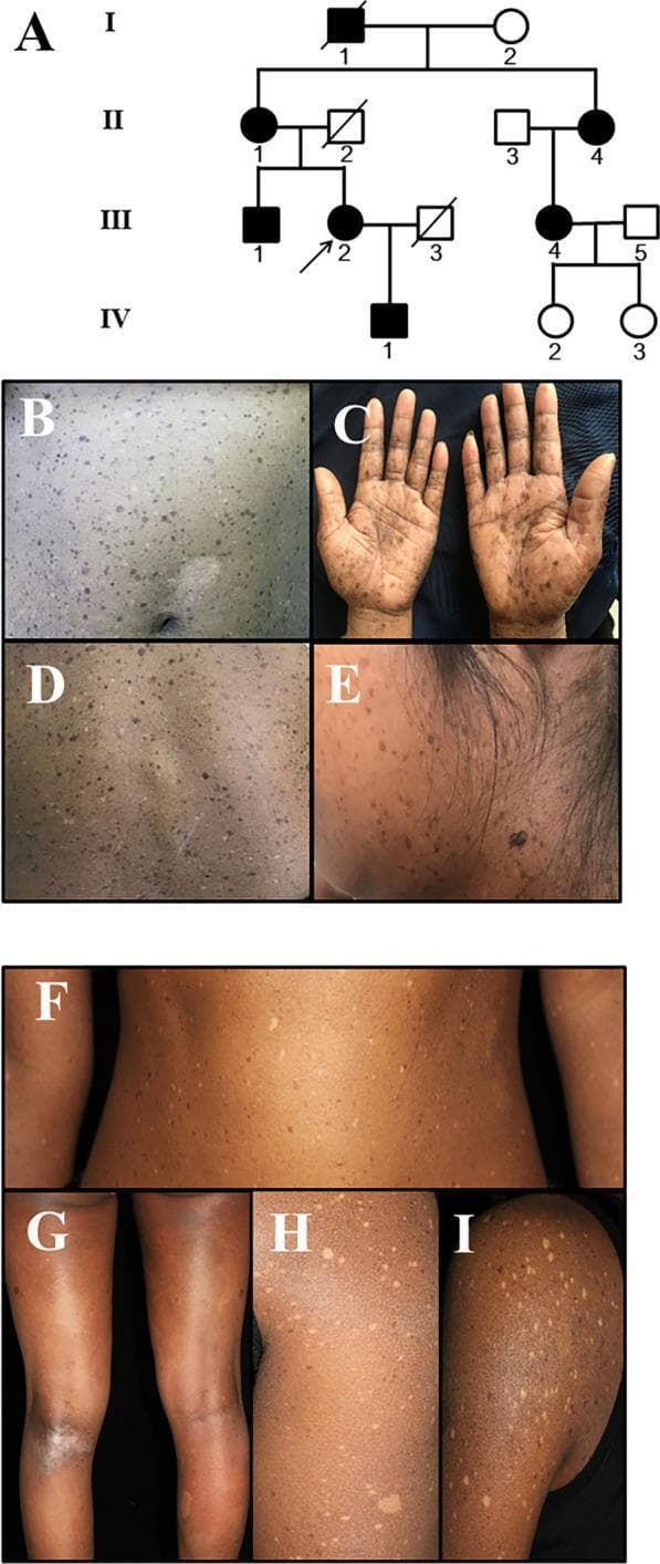 This composite educational image features a pedigree chart and clinical photographs illustrating Familial Progressive Hyper- and Hypopigmentation (FPHH). (A) A four-generation pedigree shows an autosomal dominant inheritance pattern. (B-I) Clinical photographs demonstrate a generalized, progressive pigmentary genodermatosis. The skin displays a distinctive intermixed pattern of hyperpigmented and hypopigmented lesions. Smaller macules (0.2–0.8 cm) are distributed across the face, neck, trunk, limbs, and palms (C), with larger, centimeter-scale irregular patches appearing on the trunk and extremities. The hyperpigmented areas present as dark brown lentigines and macules, while hypopigmented lesions appear as pale, depigmented spots. These findings are characteristic of mutations in the KITLG gene, which affect melanoblast migration and melanin synthesis. The image serves as a clinical reference for identifying mixed pigmentary disorders and understanding their genetic transmission in a medical genetics or dermatology context.