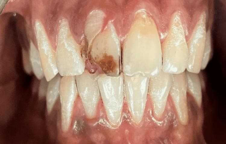 This clinical photograph displays a front-on intraoral view of the maxillary and mandibular dentition, focusing on a significant dental trauma. The maxillary right central incisor (tooth 11) presents a complicated crown fracture. The fracture line is oblique, extending from the mesial aspect toward the cervical area, resulting in a mobile coronal fragment that appears partially displaced. Notable brownish discoloration and exposed dentin are visible within the fractured area, suggesting possible pulpal involvement. The adjacent gingival tissues, particularly the interdental papilla and marginal gingiva surrounding tooth 11, exhibit signs of acute inflammation, including erythema and swelling. The surrounding teeth, including the maxillary left central incisor and lateral incisors, appear intact with normal morphology and alignment, though light plaque accumulation is visible at the gingival margins. This image serves as a clinical example of acute dental trauma requiring endodontic evaluation and restorative intervention, such as fragment reattachment or post-and-core rehabilitation.