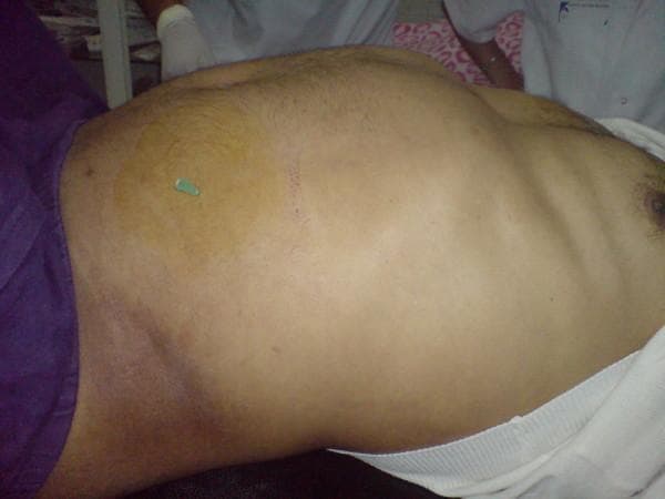 This clinical photograph displays a significantly distended and tense abdomen of a patient in a critical care setting. The abdomen shows marked protrusion, consistent with high intra-abdominal pressure seen in Abdominal Compartment Syndrome (ACS). A large, circular area of yellowish-brown skin discoloration is present on the left flank/abdominal wall, likely representing a localized antiseptic preparation or ecchymosis. Centrally within this discolored area, a 14-gauge needle (indicated by the green hub) is seen inserted percutaneously. This image illustrates the emergency bedside technique of fine-needle decompression used as a salvage procedure to relieve intra-abdominal hypertension. The photograph demonstrates the severe physical findings of abdominal tension and the immediate interventional approach to restoring hemodynamic stability in the context of critical intra-abdominal pathology.