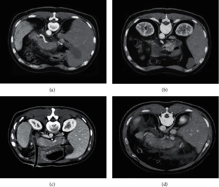 This composite diagnostic image features four axial abdominal CT scans demonstrating the spectrum of acute pancreatitis (AP) severity. Panels (a) and (b) represent mild acute pancreatitis (MAP), characterized by the pancreas showing focal or patchy low-density, non-enhancing areas. The peripancreatic fat planes remain relatively preserved with minimal fluid accumulation. In contrast, panels (c) and (d) illustrate severe acute pancreatitis (SAP). These scans reveal extensive pathology, including large, patchy peripancreatic effusion shadows and significant fluid collections in the retroperitoneal space (RPS) and anterior pararenal space (APS). The pancreatic parenchyma in SAP shows more pronounced density changes and irregular borders, reflecting higher degrees of inflammatory infiltration and potential necrosis. These images serve as educational examples for the Computed Tomography Severity Index (CTSI), highlighting the radiological differences between mild interstitial inflammation and severe exudative or necrotizing processes in the abdominal cavity.