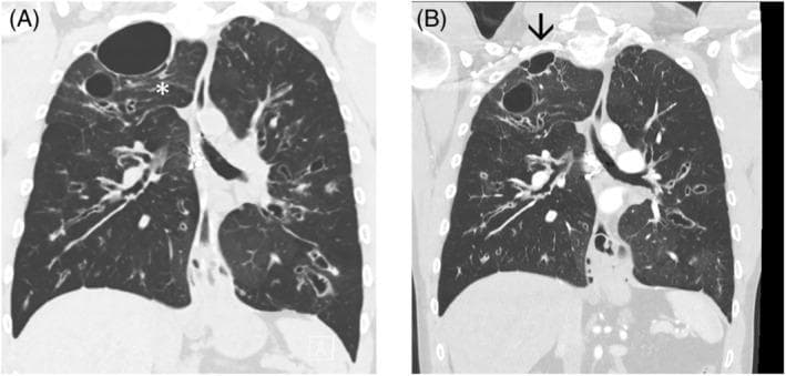 Coronal High-Resolution Computed Tomography (HRCT) of the chest comparing lung morphology before (A) and after (B) cystic fibrosis transmembrane conductance regulator (CFTR) modulator therapy. Image A demonstrates advanced bronchiectasis with prominent bronchial wall thickening, mucous plugging, and multiple cystic structures. A large, dominant air-filled cyst is visible at the right lung apex, exerting a mass effect and compression on the adjacent lung parenchyma (indicated by an asterisk). Image B, obtained 18 months post-therapy, shows a significant reduction in the size of the large apical cyst (arrow) and improvement in the expansion of surrounding lung tissue. There is a visible decrease in bronchial wall thickening and the size of varicose airways throughout both lung fields. These findings illustrate the structural lung remodeling and reduction in hyperinflation and cystic manifestations achievable with targeted pharmacotherapy in cystic fibrosis patients.