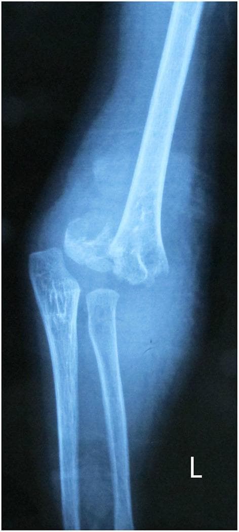 A lateral x-ray radiography of a pediatric elbow demonstrating a severe supracondylar humerus fracture, classified as a Gartland type III. The imaging reveals a complete transverse fracture line across the distal humerus, superior to the condyles. There is significant posterior displacement and angulation of the distal humeral fragment relative to the proximal humeral shaft. The anatomical alignment of the elbow joint is heavily disrupted; the normal radiocapitellar line is lost as the capitellum is displaced with the distal humeral fragment. The proximal radius and ulna remain articulated with the distal humerus but are posteriorly translated alongside it. The image serves as a clinical example of a common pediatric orthopedic emergency requiring urgent reduction to prevent neurovascular compromise or long-term deformity such as cubitus varus. This visual is typical of injuries seen in the context of a fall on an outstretched hand in children.