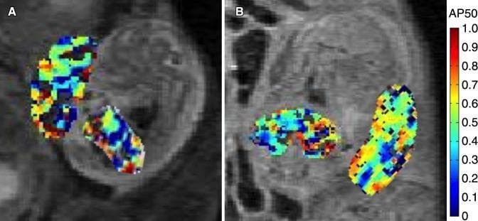 This diagnostic image set displays two functional MR images (A and B) showing maternal-fetal units in a mouse model at embryonic days 14.5 and 17.5. The images feature overlaid color-coded AP50 maps, which represent fetal and placental oxygen-hemoglobin dissociation parameters. In both panels, the placenta and fetal liver are isolated as regions of interest. A vertical color bar on the right side indicates AP50 values scaled from 0 to 1.0, with cool colors (dark blue) representing lower values and warm colors (red/orange) representing higher values. Panel A (day 14.5) demonstrates a heterogeneous distribution of oxygenation parameters within the tissues, showing a mix of green, yellow, and blue pixels. Panel B (day 17.5) illustrates the progression of these physiological markers over time, with the placental AP50 values showing a significant spatial shift toward warmer colors, reflecting changes in oxygen transfer efficiency. These maps provide a non-invasive visual method for studying fetal oxygenation and placental function during gestation.