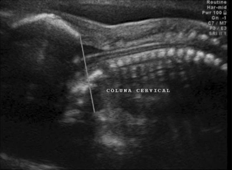 This diagnostic ultrasound image presents a sagittal view of a fetal posterior fossa and upper spine. The cervical spine is labeled 'COLUNA CERVICAL,' showing regularly spaced hyperechoic vertebral bodies. A vertical reference line, identified in clinical context as the 'occipitum-dens line,' is drawn between the lower margin of the occipital bone and the expected location of the cervical dens. This radiological landmark is used as a diagnostic tool in fetal neurosonography to evaluate the degree of hindbrain herniation (such as Chiari type II malformation) by measuring the descent of the cerebellum and brainstem relative to the foramen magnum. The image utilizes speckle reduction imaging (SRI) and harmonic imaging (Har-mid) to enhance tissue differentiation. This visual serves as a critical educational example of prenatal screening for neural tube defects and associated intracranial complications like hydrocephalus and posterior fossa crowding.