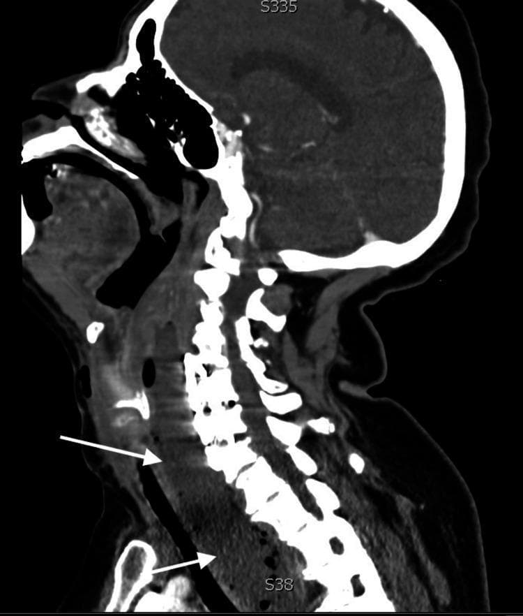 This diagnostic image is a sagittal computed tomography (CT) scan of the head, neck, and upper chest, highlighting a large retropharyngeal abscess. The visual reveals a significant, hypodense, and heterogeneously textured collection in the retropharyngeal space, marked by white arrows. The abscess originates at the level of the cervical spine and extends inferiorly through the deep neck spaces into the superior mediastinum. The mass effect is clinically significant, showing marked anterior displacement and compression of the trachea, along with narrowing of the glottic and subglottic airway regions. The cervical vertebrae are visible posterior to the collection, with some hyperdense artifacts suggesting possible spinal hardware. This image illustrates the critical pathophysiology of descending necrotizing mediastinitis and the acute risk of airway obstruction associated with deep neck space infections. It is a vital educational resource for identifying radiological signs of abscess progression and secondary mass effects on vital aerodigestive structures.