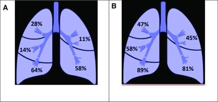 This medical comparison chart consists of two anatomical diagrams (A and B) representing the human lungs in a coronal view. Diagram A illustrates the anatomical distribution of pulmonary artery thrombosis, while Diagram B shows the distribution of inflammatory lung lesions, likely in the context of COVID-19. Both diagrams divide the lungs into five regions: the right superior, middle, and inferior lobes, and the left superior and inferior lobes. In Diagram A (Thrombosis), percentages range from 11% in the left superior lobe to 64% in the right inferior lobe. In Diagram B (Inflammation), percentages are significantly higher, ranging from 45% in the left superior lobe to 89% in the right inferior lobe. Both visualizations demonstrate a distinct predilection for the lower lobes compared to the upper and middle lobes. This anatomical mapping is intended to correlate the location of vascular complications with parenchymal inflammatory changes, highlighting the regional severity of pulmonary pathology.