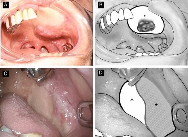 This composite educational image illustrates macroscopic findings and schematic representations of secondary neoplasms arising on reconstructive flap skin paddles in the oral cavity. Panels A and B present a clinical photograph and corresponding diagram of a flap neoplasm located centrally on the skin paddle. The lesion is characterized by focal erythema and a protruding, partially elevated morphology. Panels C and D show a clinical photograph and diagram of a similar lesion that demonstrates erythema and partial elevation extending toward the skin-mucosa junction, representing a peripheral or junctional presentation. These images demonstrate the typical macroscopic features of 'flap cancers,' which in these clinical cases were histologically confirmed as well-differentiated squamous cell carcinomas. The visual focus is on the distinguishing features of secondary primary neoplasms arising in surgical flaps, highlighting the importance of monitoring skin paddles for new lesions such as erythema, papillary projections, or non-ulcerative protrusions.