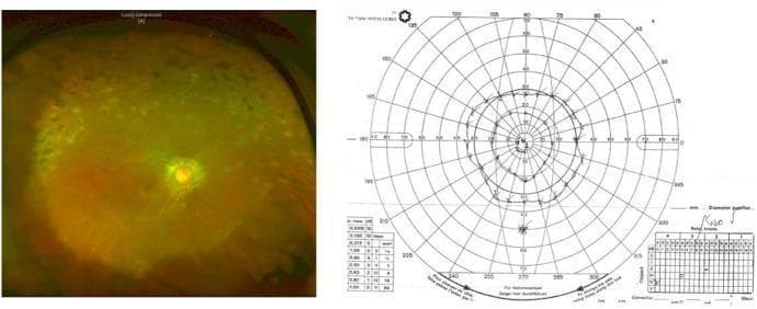 This composite educational figure consists of a pseudo-color ultra-widefield fundus photograph and a corresponding Goldmann visual field (GVF) kinetic perimetry chart of a right eye. The fundus image displays clear vitreous media and significant peripapillary scarring surrounding the optic nerve head. The peripheral retina shows diffuse, mottled hypo- and hyperpigmented choroidal lesions, characteristic of chronic inflammatory sequelae such as sympathetic ophthalmia. The GVF chart demonstrates severe concentric visual field constriction. Specifically, the outermost isopter at maximal light intensity (4dB) is restricted to approximately 30 degrees from the fovea, while a lower intensity stimulus (3dB) further constricts the perceived field to 20 degrees. This clinical pairing illustrates the correlation between peripheral retinochoroidal atrophy and significant functional visual loss, relevant for advanced ophthalmology education regarding uveitis complications and the assessment of permanent retinal damage.