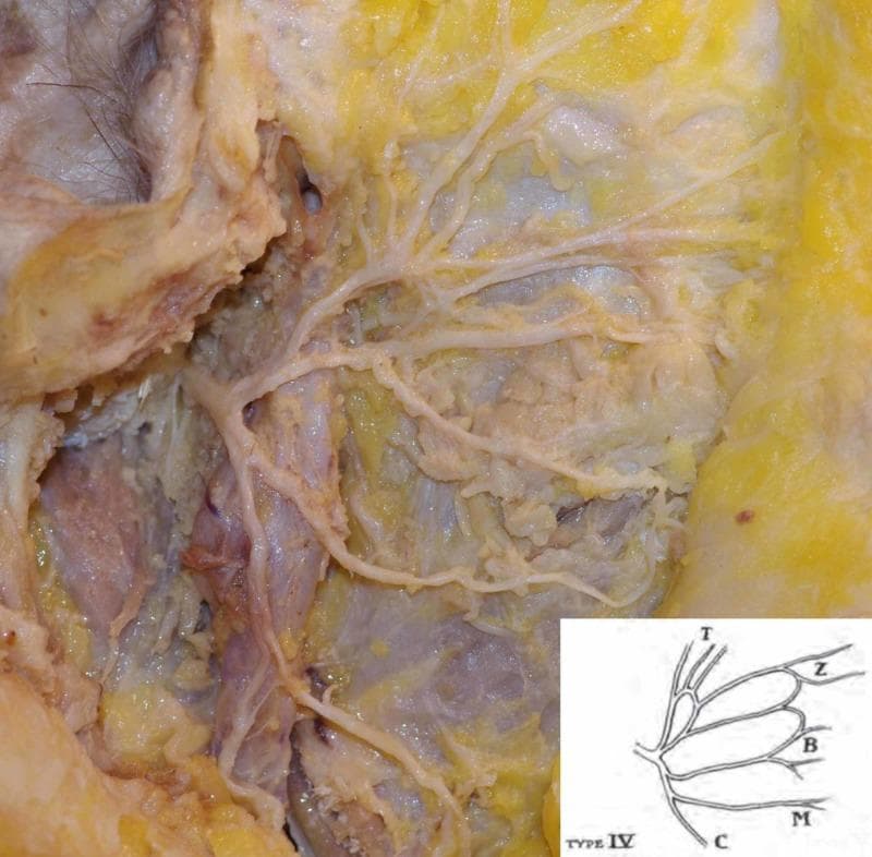 This clinical photograph displays a gross anatomical dissection of the right facial nerve (Cranial Nerve VII) within the parotid region. The image demonstrates a single facial nerve trunk that undergoes bifurcation into primary upper and lower divisions. Following this initial split, the nerve exhibits a complex, interconnected branching pattern identified as Davis Type IV. Multiple secondary branches are visible radiating across a bed of yellowish adipose tissue and the masseter muscle fascia. These branches eventually form the terminal ramifications: temporal (T), zygomatic (Z), buccal (B), marginal mandibular (M), and cervical (C) branches. The parotid gland tissue has been partially reflected to expose the pes anserinus. This specimen serves as an educational example of neuroanatomical variation, specifically highlighting the Davis classification system for surgical planning in parotidectomy and facial reconstructive procedures.