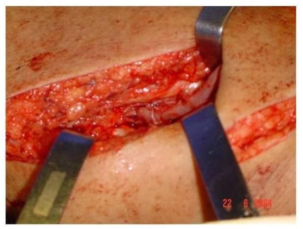 This clinical photograph shows an intraoperative view of a vascular surgery site, specifically an anastomosis between the saphenous vein and the superficial femoral artery (SFA). The surgical field is exposed via a longitudinal incision in the thigh, with metal retractors (Farabeuf or similar) providing retraction to reveal the subcutaneous fat and deeper vascular structures. The vessels appear reddish-pink, and the surgical site demonstrates standard vascularization with visible fine sutures, likely 6-0 polypropylene, at the anastomotic junction. The image illustrates the technical execution of an arteriovenous fistula (AVF) creation, where the saphenous vein is joined end-to-side to the superficial femoral artery. This procedure is typically performed for hemodialysis access in patients with suitable arterial and venous anatomy. The educational focus is on vascular dissection, exposure of the femoral vessels in the adductor canal region, and the precise placement of anastomotic sutures.