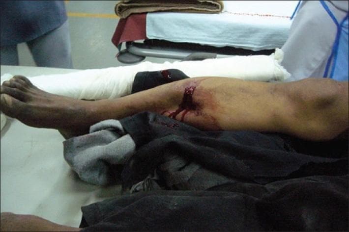 This clinical photograph displays a high-energy trauma injury to the right lower extremity of a patient in an emergency department setting. The image demonstrates a significant open (compound) fracture of the mid-shaft tibia and fibula. A large, transverse, irregular skin laceration is visible on the anterior-medial aspect of the leg, with active hematoma and fresh blood tracking down the skin. There is evident soft tissue maceration and substantial deformity of the limb's anatomical alignment, suggesting a complete fracture. The patient's leg is positioned on a medical table covered with dark clothing/fabric. Distal to the injury site, the lower leg and ankle are partially supported by white cotton padding/bandaging, serving as a temporary stabilization or splint. Proximally, near the knee, a black support material or brace is visible. This image serves as a clinical example of severe orthopedic trauma requiring immediate irrigation, stabilization, and surgical intervention.