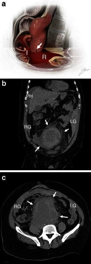 This educational image set illustrates the combined intraperitoneal and retroperitoneal hemorrhage resulting from an abdominal aortic aneurysm (AAA) rupture. Panel A is a pathophysiology diagram depicting a left anterolateral wall rupture (white arrow) of a large AAA, showing blood extending into both the retroperitoneal (R) and intraperitoneal (I) spaces. Panels B and C are unenhanced CT scans (coronal and axial views, respectively) of a 51-year-old male. The imaging demonstrates a high-attenuation (60 HU) acute intraperitoneal hematoma involving the perihepatic space (PH), right paracolic gutter (RG), and left paracolic gutter (LG). Concurrently, a large retroperitoneal hematoma is identified by white arrows surrounding the aneurysm and extending along the posterior abdominal wall. This content demonstrates key radiological signs of acute aortic rupture, specifically highlighting that anterior or anterolateral ruptures often lead to hemoperitoneum, complicating the typical retroperitoneal presentation of AAA emergencies.