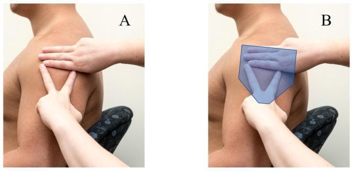 Clinical photograph and anatomical diagram demonstrating anatomical landmarking for intramuscular injection into the deltoid muscle. Figure A shows a manual palpation technique: one hand is placed horizontally across the superior aspect of the shoulder to identify the acromion process, while the other hand forms a 'V' shape with the index and middle fingers on the lateral aspect of the upper arm to locate the deltoid tuberosity. Figure B includes a semi-transparent blue overlay representing the anatomical boundaries and bulk of the deltoid muscle in relation to the hand positioning. This visual guide illustrates the Australian Immunisation Handbook's recommended technique for identifying the 'safe zone' for deltoid injections, minimizing the risk of shoulder injury related to vaccine administration (SIRVA) or subacromial-subdeltoid bursitis. The educational focus is on surface anatomy, musculoskeletal landmarks, and clinical nursing skills for safe immunization practices.