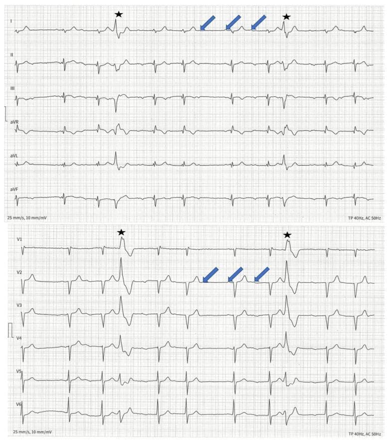 This diagnostic image displays a 12-lead electrocardiogram (ECG) tracing on a standard grid (25 mm/s, 10 mm/mV) demonstrating significant conduction abnormalities. The ECG features a second-degree type I atrioventricular (AV) block, also known as Wenckebach phenomenon. Blue arrows in leads I and V2 highlight P-waves, illustrating a progressive prolongation of the PR interval (PQ interval) in successive beats until a P-wave fails to conduct to the ventricles, resulting in a dropped QRS complex. Additionally, the tracing shows ventricular ectopy in the form of premature ventricular contractions (PVCs), identified by black stars in leads I and V1. These PVCs exhibit characteristic wide, distorted QRS complexes followed by compensatory pauses. The ECG is representative of cardiac conduction system disease, often associated with laminopathies (LMNA mutations), and serves as an educational tool for identifying progressive AV nodal delay and ectopic ventricular activity in the context of inherited cardiomyopathies.