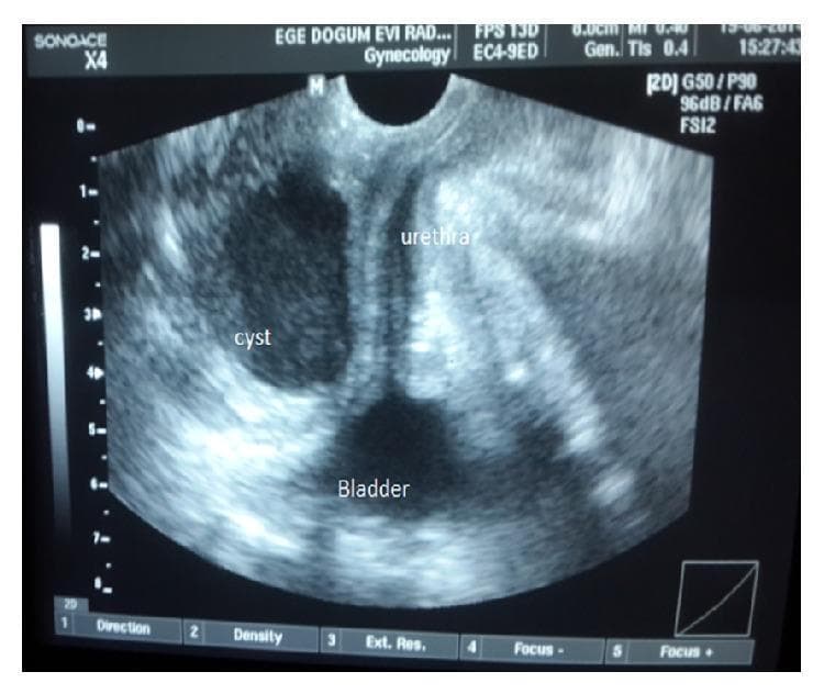 This diagnostic image is a gray-scale perineal ultrasonography of the female lower urinary tract. The ultrasound demonstrates the anatomical relationship between the bladder, urethra, and a vaginal wall cyst. The bladder is visible as a hypoechoic structure at the bottom of the field (inferior). Emerging from the bladder neck, the urethra is shown in a longitudinal orientation, appearing centrally. A well-defined, hypoechoic, oval-shaped cyst is positioned lateral to the urethra and superior to the bladder. The cyst displays distinct borders and lack of internal echoes, suggesting a fluid-filled nature, such as a Müllerian cyst. Notably, the image highlights the lack of communication or continuity between the cystic lesion and the urinary tract structures (bladder and urethra), which is a key diagnostic feature in differentiating vaginal cysts from urethral diverticula or cystoceles. This clinical imaging is relevant for gynecology and urology education regarding pelvic floor masses and differential diagnosis of anterior vaginal wall lesions.
