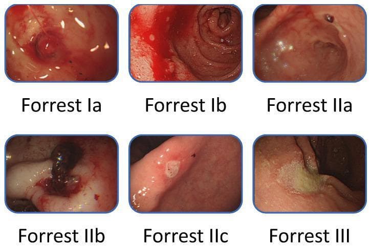 This composite educational clinical image demonstrates the Forrest classification for peptic ulcer bleeding (PUB) via six gastroscopic panels. Top row (Active Bleeding): Forrest Ia shows 'spurting hemorrhage' with an arterial jet; Forrest Ib shows 'oozing hemorrhage' without a visible vessel. Middle and bottom rows (Recent Hemorrhage Signs): Forrest IIa depicts a 'non-bleeding visible vessel' as a protuberant lesion; Forrest IIb shows an 'adherent clot' covering the ulcer base; Forrest IIc presents 'flat pigmented spots' (hematin) indicating recent stasis; and Forrest III displays a 'clean-based ulcer' with a white fibrin base and no stigmata of hemorrhage. This classification system is essential for gastroenterologists to assess rebleeding risk and determine the necessity of endoscopic hemostasis therapy during emergency esophagogastroduodenoscopy (EGD).