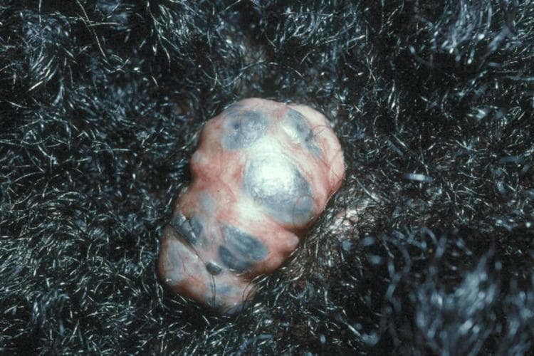 This clinical photograph displays a 2.5 x 1.5 cm pedunculated, exophytic nodule located on the scalp, surrounded by dense, dark, curly hair. The lesion exhibits a multi-lobulated, irregular morphology with a complex pigmentary pattern. The base of the nodule is predominantly flesh-toned to erythematous, interspersed with distinct, irregular macules of dark brown, slate-gray, and bluish pigmentation. The surface appears smooth but uneven due to the internal lobulations and variable pigment distribution. Clinically, this presentation is characteristic of a pigmented basal cell carcinoma, which may arise within a pre-existing lesion such as a nevus sebaceous. The image serves as an educational example of dermatologic oncology, highlighting the morphological diversity of basal cell carcinoma in patients with darker skin phototypes and the importance of evaluating scalp nodules that exhibit changes in size, texture, or pigmentation.