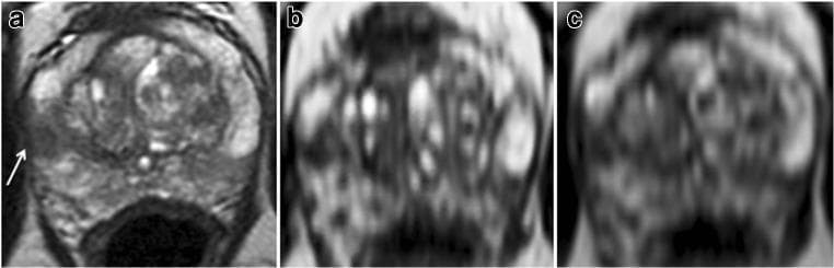 Diagnostic Image Comparison: Comparison of three axial T2-weighted magnetic resonance images (MRI) of the prostate gland at the mid-gland level. Panel (a) shows a conventional 2D axial T2WI demonstrating a hypointense lesion in the right lateral peripheral zone (PZ) marked with a white arrow. In this standard sequence, the lesion appears to have a broad tumor-capsule contact length of 12 mm. Panels (b) and (c) represent 3D thin-sliced cube reformats at two consecutive levels of the same region. These high-resolution reformats clarify the anatomy by reducing partial volume effects, revealing a more minimal capsular contact of approximately 5 mm. The images illustrate the clinical utility of 3D T2W reformatting for more accurate staging of prostate cancer by precisely evaluating the tumor-capsule interface and predicting extra-prostatic extension (ECE). The case relates to a 65-year-old patient with elevated PSA, where histopathology confirmed an organ-confined (pT2) Gleason 4+4=8 lesion.